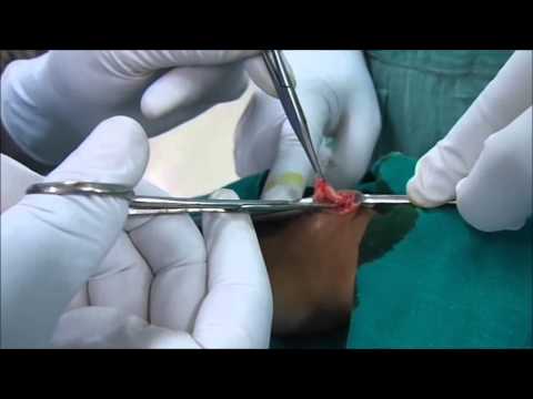 Welche Übungen sollte mit einem Leistenbruch in der Halswirbelsäule durchgeführt werden Osteochondrose des Halses, an dem der Arzt fragen