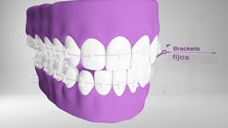 Ortodoncia para corregir la posición de los dientes. DENTIX