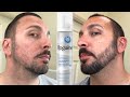 The Best 19 Using Minoxidil Rogaine Beard Before And After