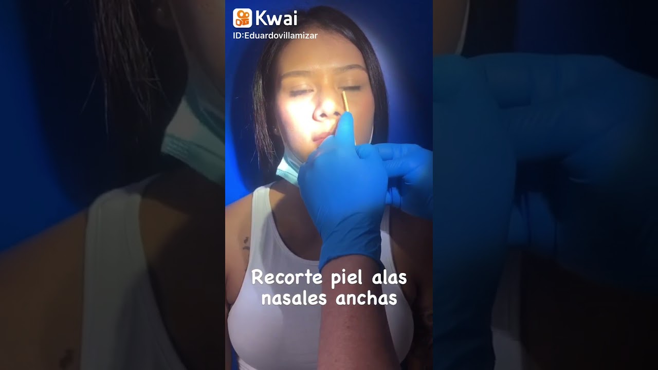 Watch Cirugía recorte de alas nasales #rinoplastia #cirugiaplastica #colombia #medellin Now Cirugía recorte de alas nasales #rinoplastia #cirugiaplastica #colombia #medellin