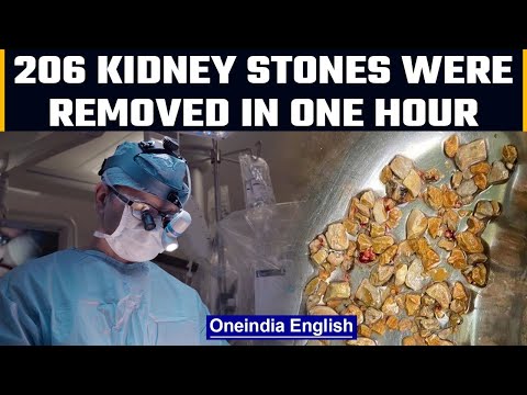 206 kidney stones removed from 56-year-old man in Hyderabad | Oneindia News
