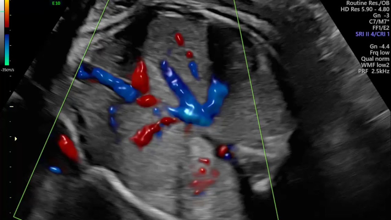 AVALIAÇÃO DE CIRCULAÇÃO HEPÁTICA EM FETO DE 30 SEMANAS