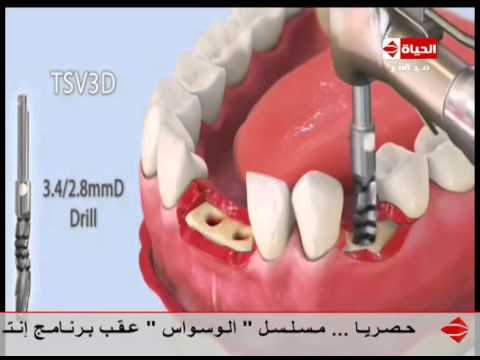 إنتبهوا أيها السادة - " د/محمد عماد " - فيديو يوضح عملية زراعة الأسنان