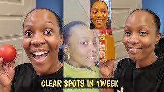 YOU WILL NEVER HAVE  BLACK SPOTS,ACNE & PIMPLES AFTER USING THIS REMEDY FOR 1 WEEK/Jalia Walda
