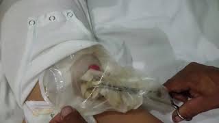 Como limpiar la bolsa de colostomia  de tu bebé.