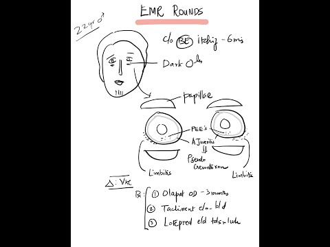 Case 5: Vernal Kerato Conjunctivitis (VKC) - Pharmacotherapy