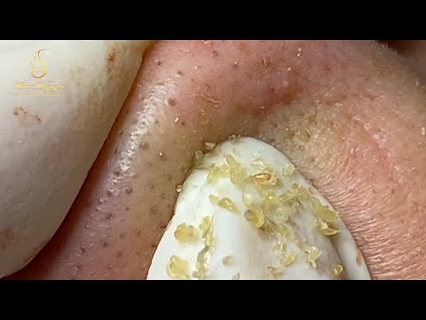Loan Nguyen Acne Treatment (#111)