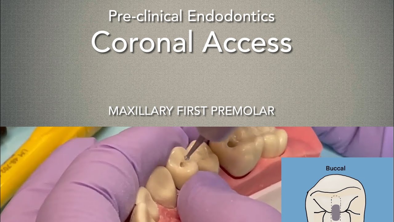 Coronal Access (Maxillary First Premolar)