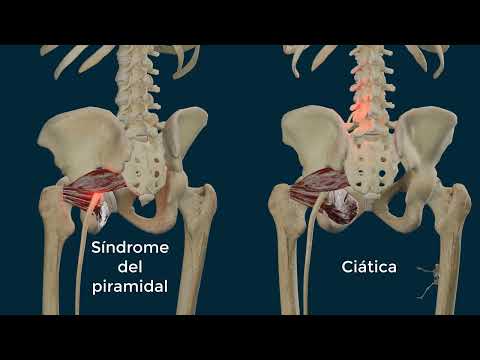 Piriformis Muscle | Sciatica vs. False Sciatica