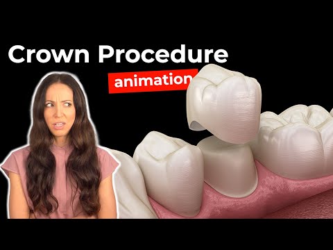 Dental Crown Procedure at the Dentist