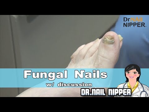 Tila tulad ng isang halamang-singaw sa kuko Makatulong sa gamutin ang toenails