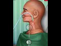 Nasal Tube Insertion Animation Video Plastic Surgery Animation Video Bkmtoon
