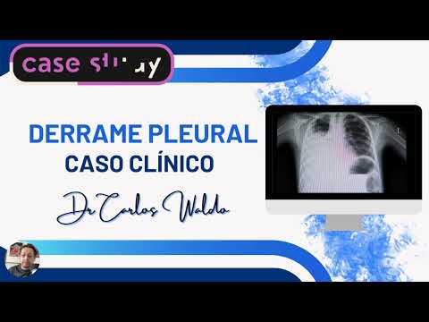 DERRAME PLEURAL  CASO CLÍNICO