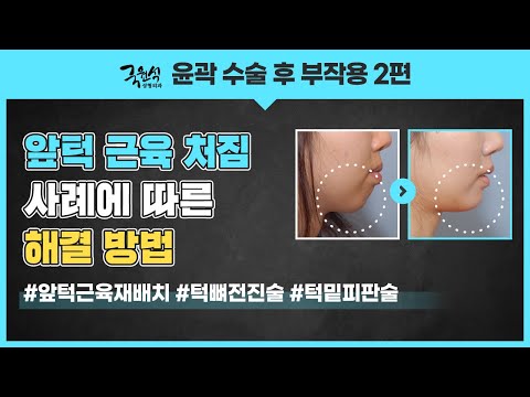 윤곽수술 부작용! 해결할 수 있는 3가지 방법!
