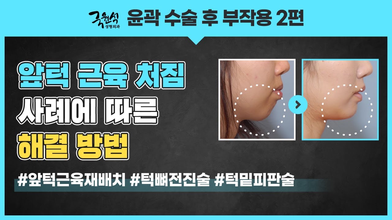 윤곽수술 부작용! 해결할 수 있는 3가지 방법! 썸네일