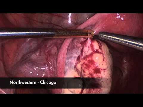 Laparoscopic Ovarian Fixation