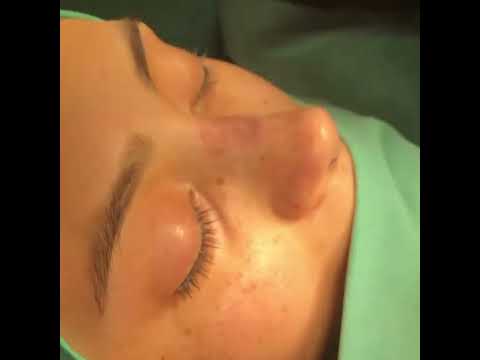 Op. Dr. Ayşe Karakaya | Eskişehir Nose Aesthetics | #Rhinoplasty #NoseAesthetics #Discover #HealthTourism