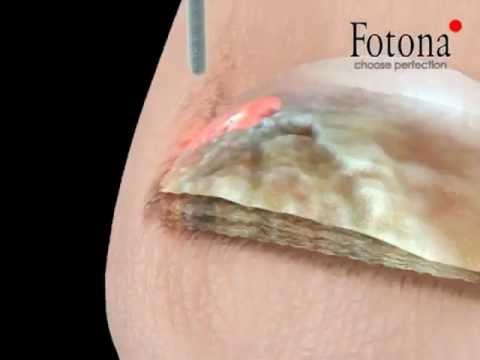 Kung paano sa paggamot sa isang pigsa malapit sa kuko sa kamay Fungus maselang bahagi ng katawan pagalingin