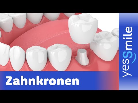 Der komplette Ablauf einer Zahnkronen-Behandlung: Was Sie erwartet I YesSmile