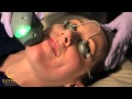Acleara Acne Laser System at Germain Dermatology ...