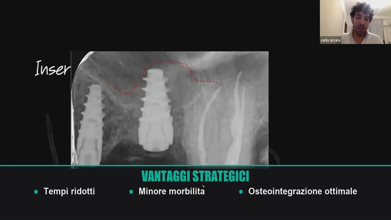 Webinar Dr. Carlo Arcara - Sinus Lift e Carico Immediato con Magnetic Mallet