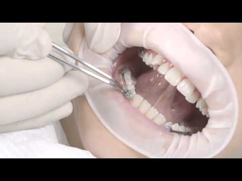 Carriere® Motion™ Class III Appliance Video Placement