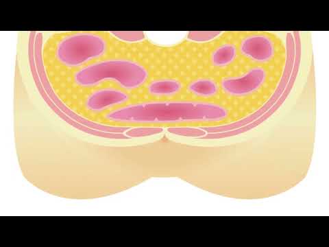 TOFI: The Hidden Health Risk in Slim Bodies