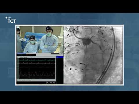 TCT 2021 - Live Retrograde CTO PCI