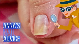 Nail Separation | Causes | Early Treatment of Onycholysis [Anna
