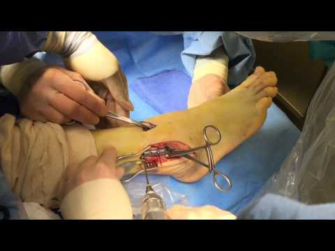 Ankle Fracture Surgery Video