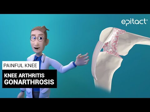 térdízületi készítmények gonarthrosis