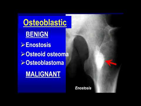 Bone tumour and tumor like lesions