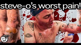 The Horrific Details Of My Most Painful Injury Ever | Steve-O