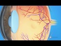 What is cystoid macular edema?