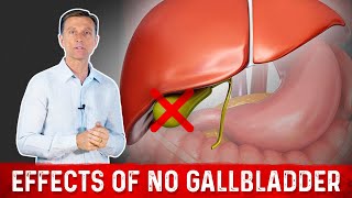 What You MUST Know If You Don't Have a Gallbladder