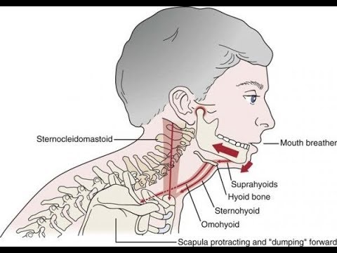 A common cause of TMD: Suprahyoid muscle clenching