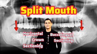 Split Mouth- Horizontal Crown Sectioning vs Buccolingual