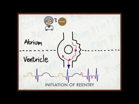 Re-entry tachycardia mechanism