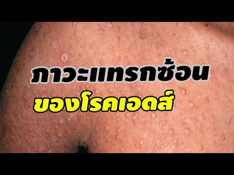 กลากรูปภาพก้นกบ Indermit ในโรคสะเก็ดเงิน