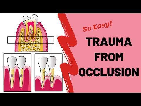Trauma From Occlusion (TFO) | PERIODONTOLOGY