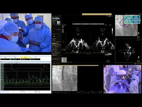 World first live transmission of Abbott's Tendyne™ TMVI