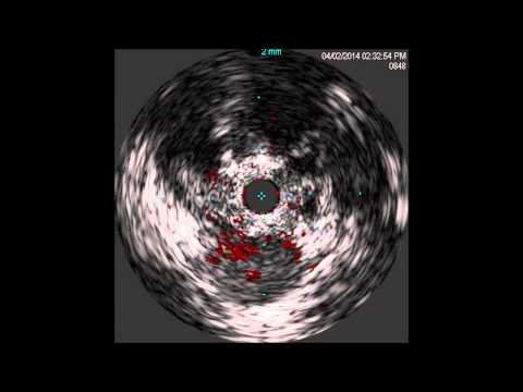 Ostial SFA CTO Cross with Viance and Subintimal Re-entry with Enteer