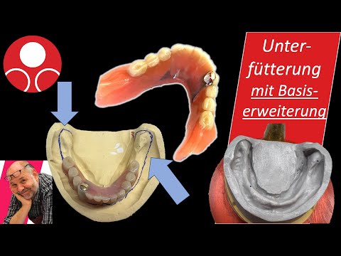 Unterfütterung mit einer Basiserweiterung