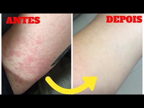 Radon da psoriasi Unguento antiincendiario a dermatite atopic