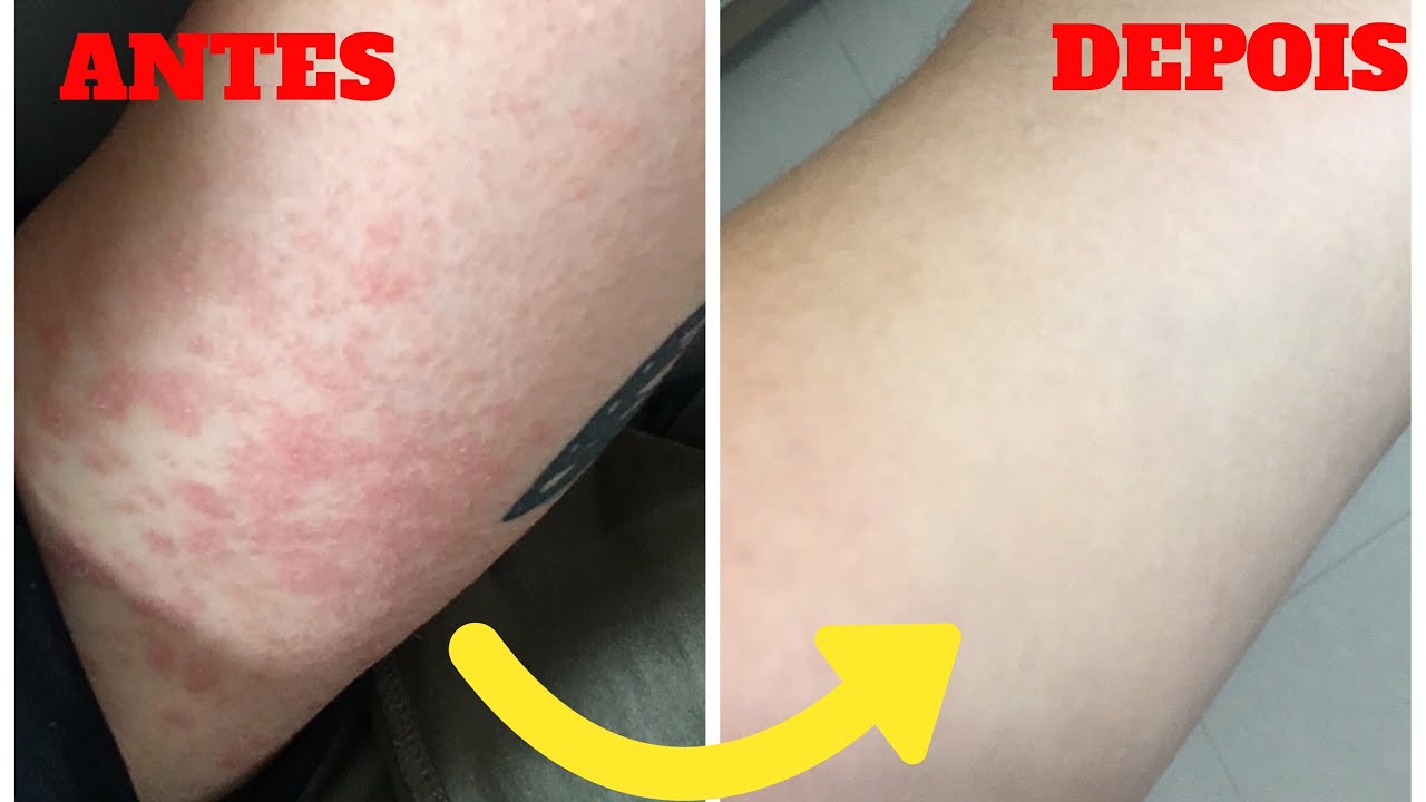 COMO CUREI A DERMATITE ATÓPICA | Bruna Panizo