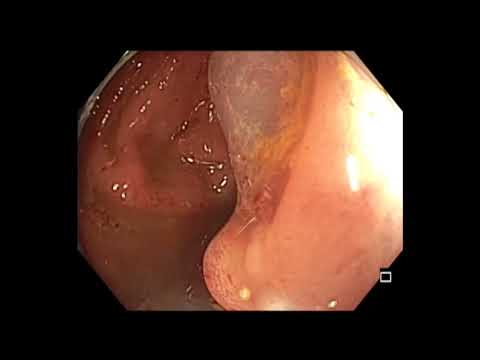 Colonoscopy: Descending Colon Polyp EMR in a Patient with Ileostomy - how to prepare the colon?