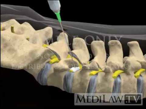 Lumbar Spine Selective Nerve Root Block Injection pain management movies