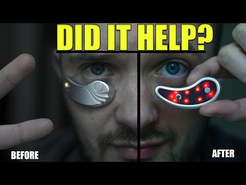 Eyepods Eye Massager 2-Week Review - Did It Help With Dark Circles & Puffiness?