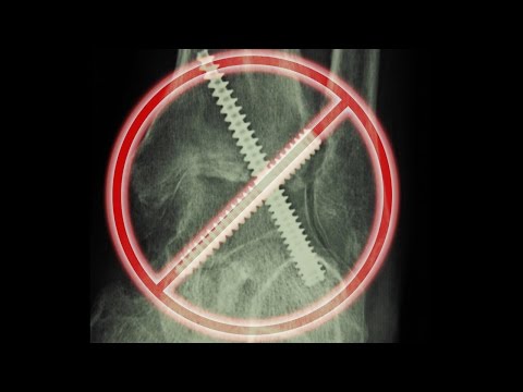 Metatarso del tarso Congenita contratture in flessione dellarticolazione del ginocchio