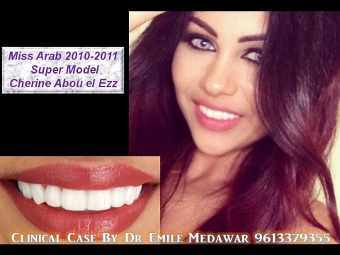 hollywood smile beirut lebanon, veneers / lumineers